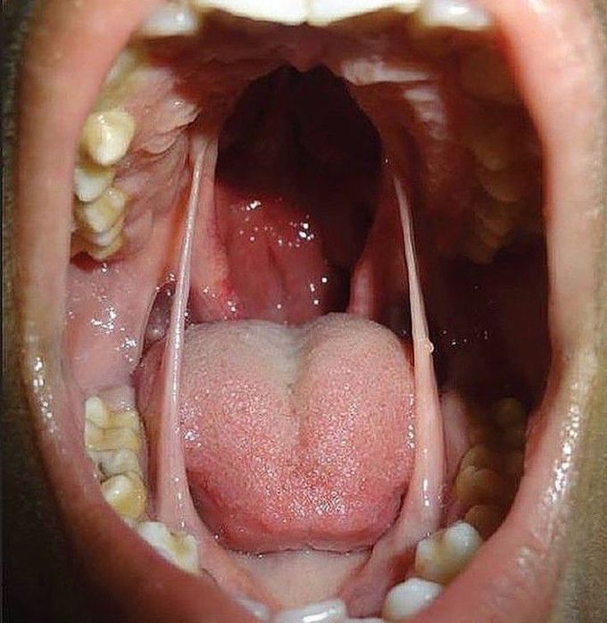 Cleft Palate