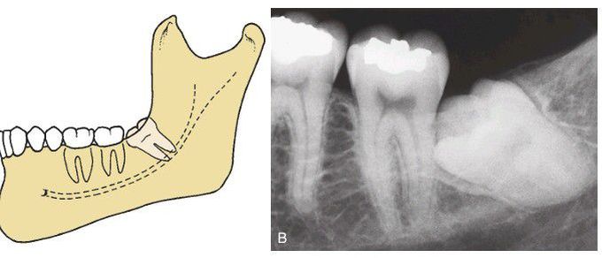 Mesioangular impaction