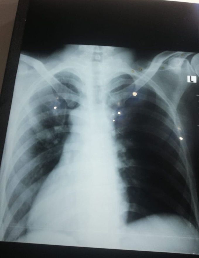 Dextrocardia