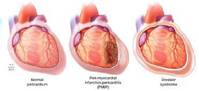 Dressler syndrome