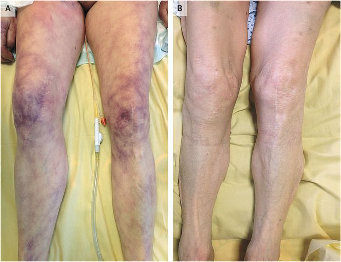 Skin Mottling
