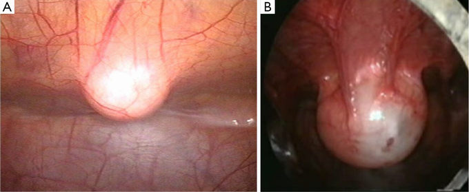 Intra-abdominal appearance of urachal cyst. (A) Non-inflamed urachal cist; (B) pyourachus, inflamed cyst.