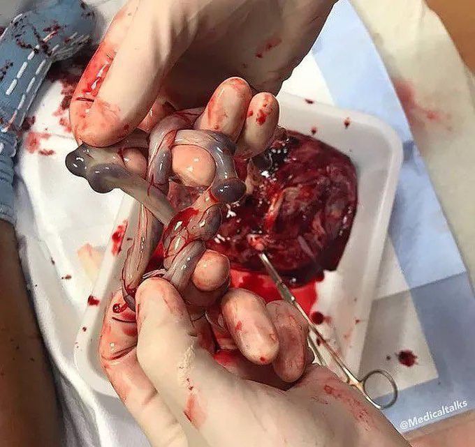 A trueknot of the umblical cord