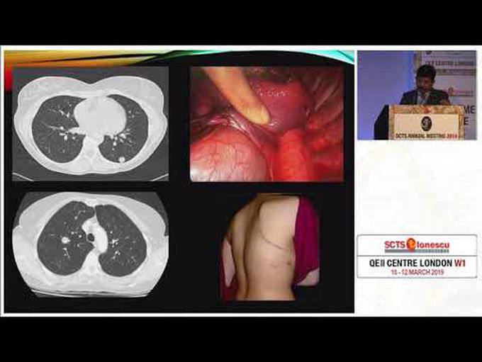 Surgical Approaches to Pulmonary Neuroendocrine Tumors