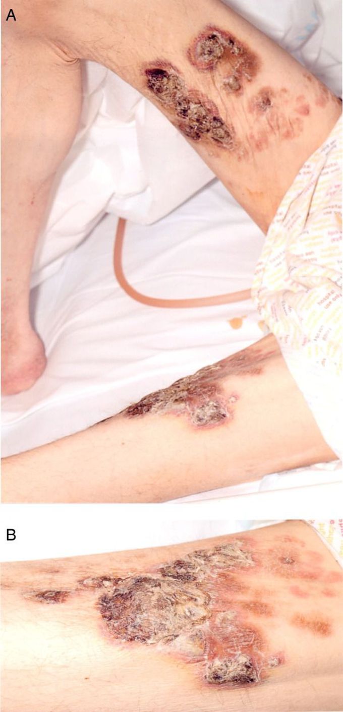 Consequences of Heavy Alcohol Use and Malnutrition
