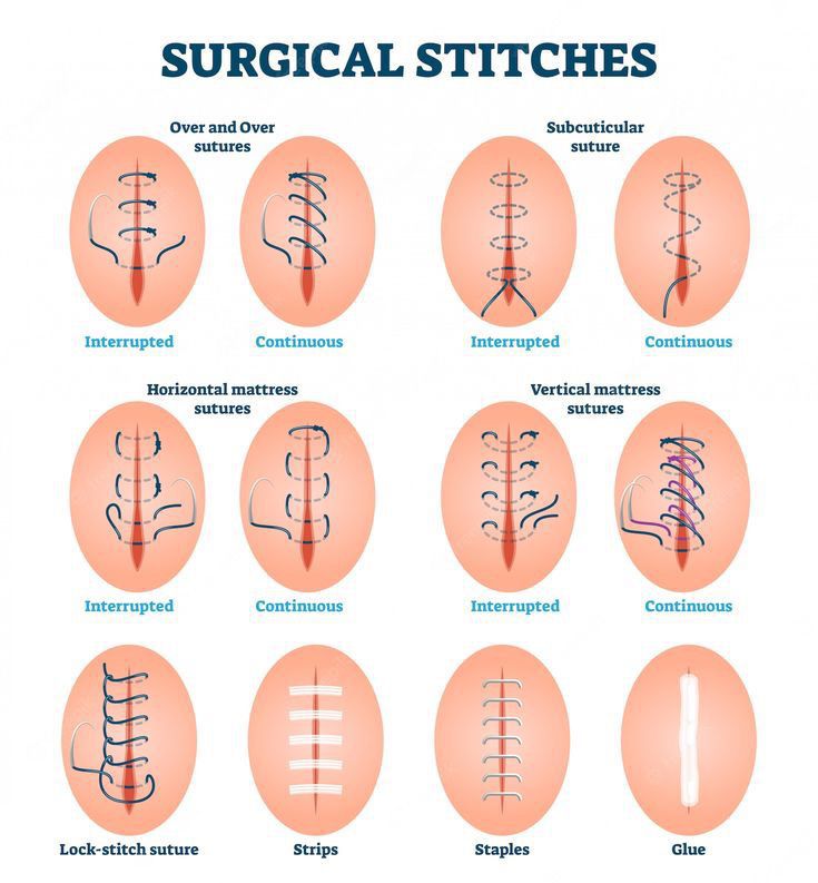 surgical-sutures-medizzy