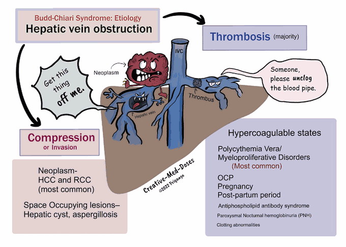 Budd-Chiari Syndrome Etiology