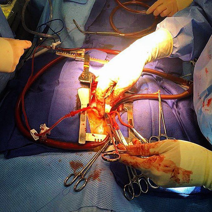 Pulmonary valve surgery!