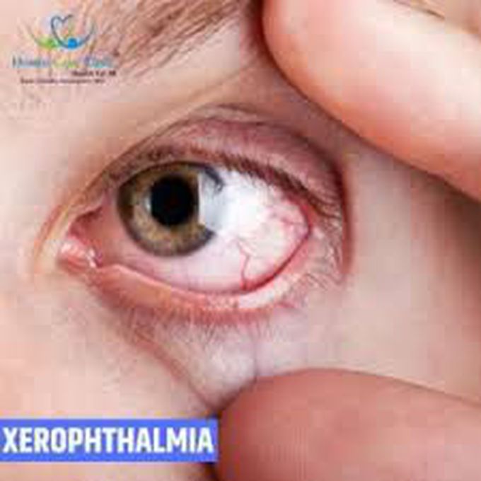 Xerophthalmia