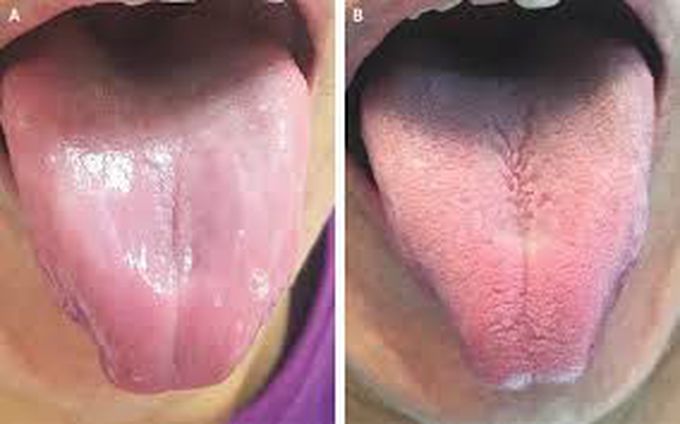 Treatment of atrophic glossitis