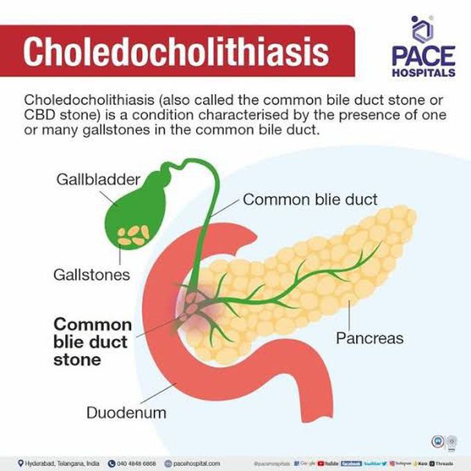 Choledocholithiasis