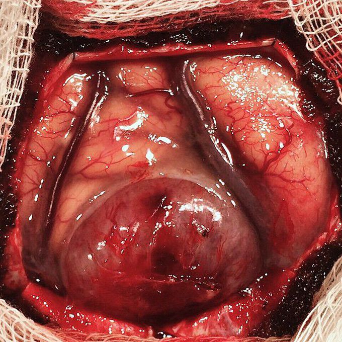 Meningioma in a 62 year old female presenting with right lower limb weakness
