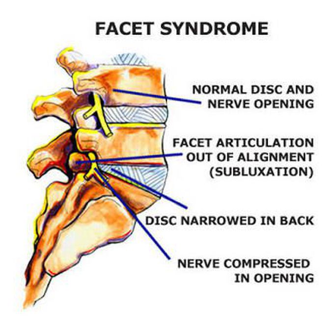 Common chronic neck pain