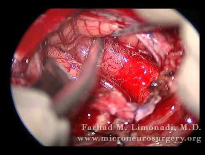 Subocciptial Craniectomy Removes Medulloblastoma Brain Tumor