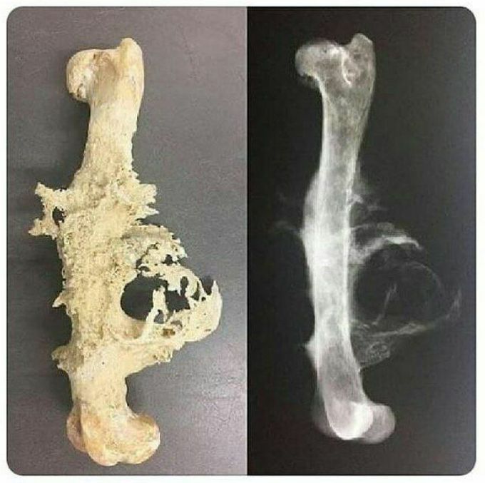 An osteosarcoma is a cancerous tumor in a bone. it is an aggressive malignant neoplasm that arises from primitive transformed cells of mesenchymal origin (and thus a sarcoma) and that exhibits osteoblastic differentiation and produces malignant osteoid. Osteosarcoma is the most common histological form of primary bone sarcoma.