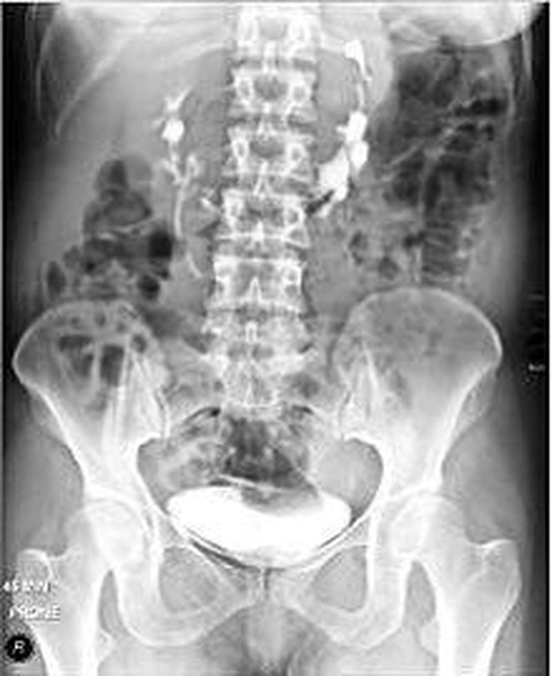 Intravenous pyelogram showing horseshoe kidney. In this MEDizzy