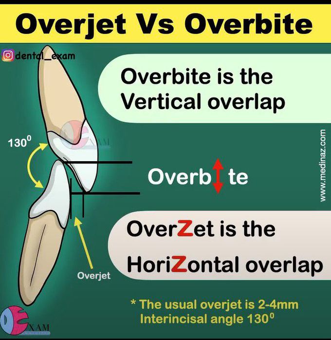 Overjet Vs Overbite