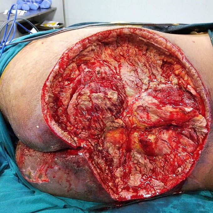 Pressure Ulcer!