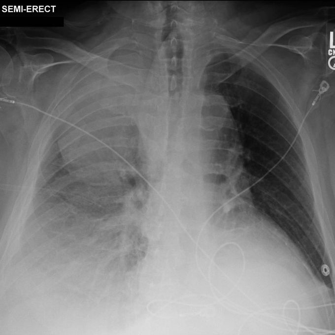 A Ruptured Aorta- Chest X-ray