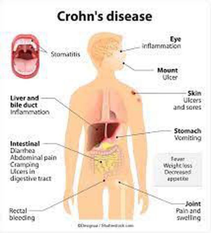 What causes Crohn’s disease?