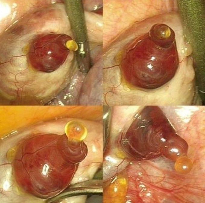 Ovulation