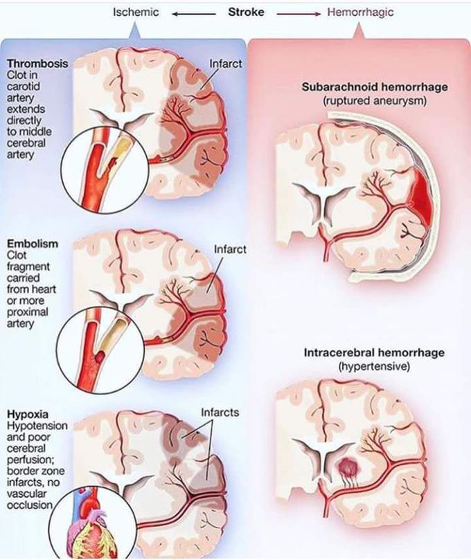 Ischemia and Hemorrhagic