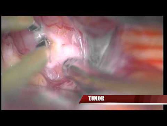 Interhemispheric approach and microsurgical resection of pineal parenchymal neoplasm ...