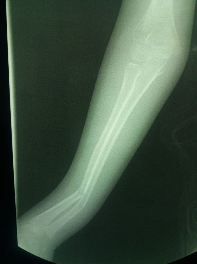 Green stick fracture