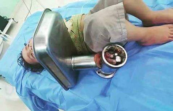 3yr old boy got hand stuck in grinder