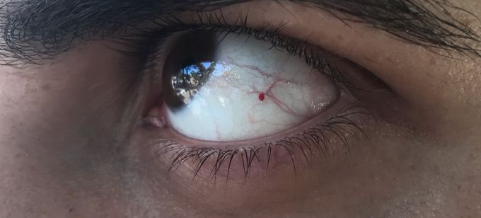 Red point in the eye