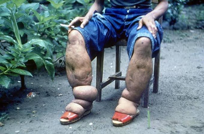 Lymphatic flariasis or elephantiasis