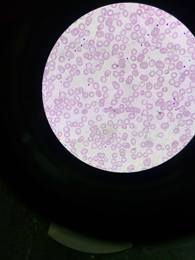 This is anaemia?