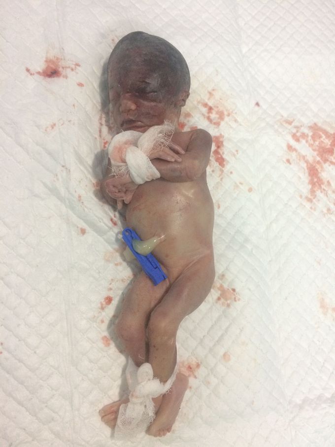 Intrauterine Fetal Death