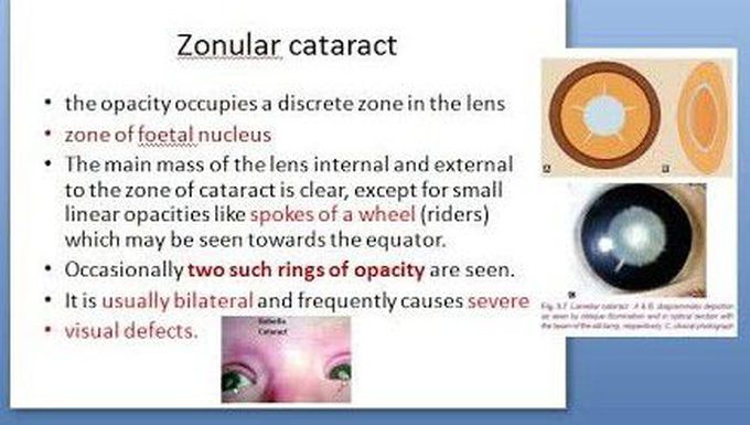 Zonular Cataract