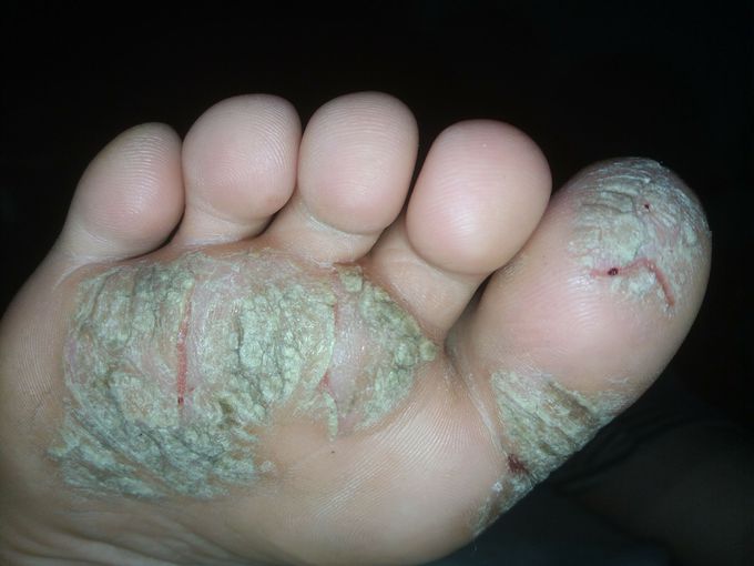 psoriasis 😔 this is my sister's feet