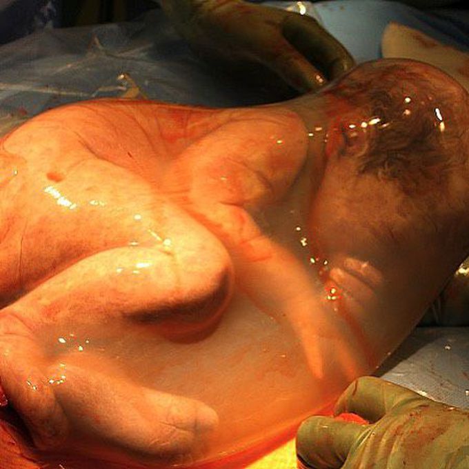 Breathtaking photo of a baby delivered via c-section but was still inside the amniotic sac!