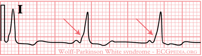 Wolff-Parkinson White Syndrome