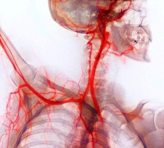 Coloured X-ray or arteriogram or angiogram of neck and shoulder arteries