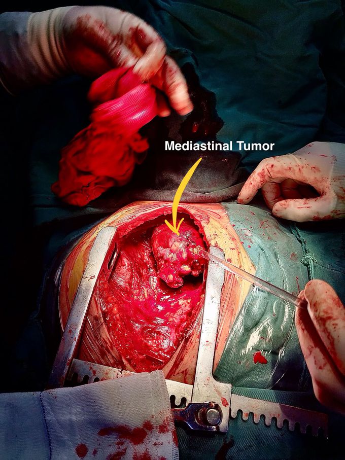 Mediastinal Tumor