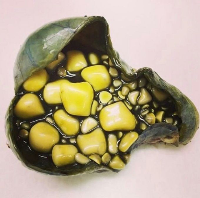 Gallstones