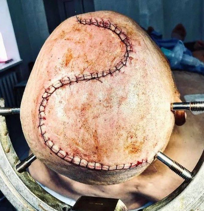 S -shaped incision