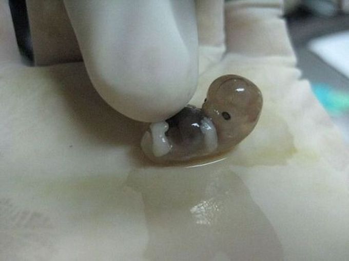 Human embryo