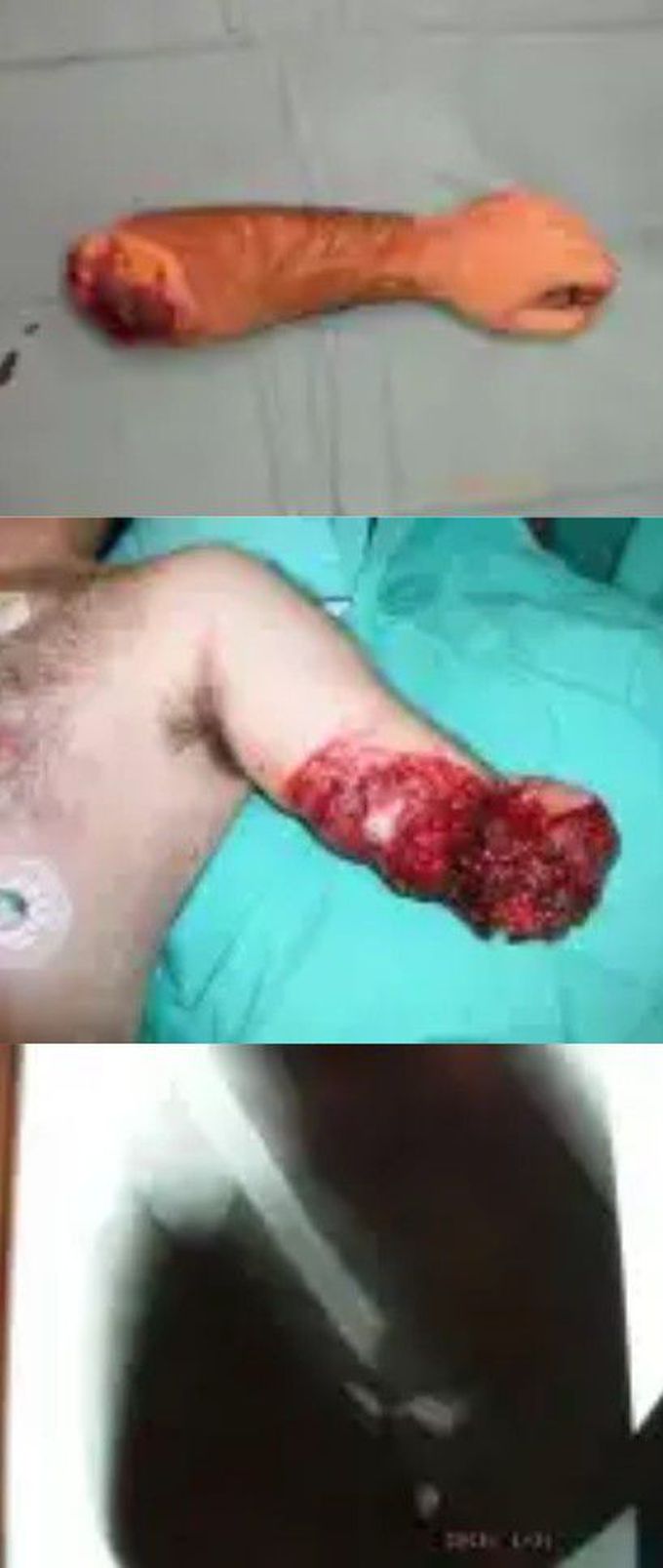 Limb-to-crotch. Repost

Israel Sarrió arrived at the Rehabilitation Center of Levante from Hospital Peset in Valencia (Spain) on January 31st of 2004 with an amputation of the left arm 2 inches above the elbow.
