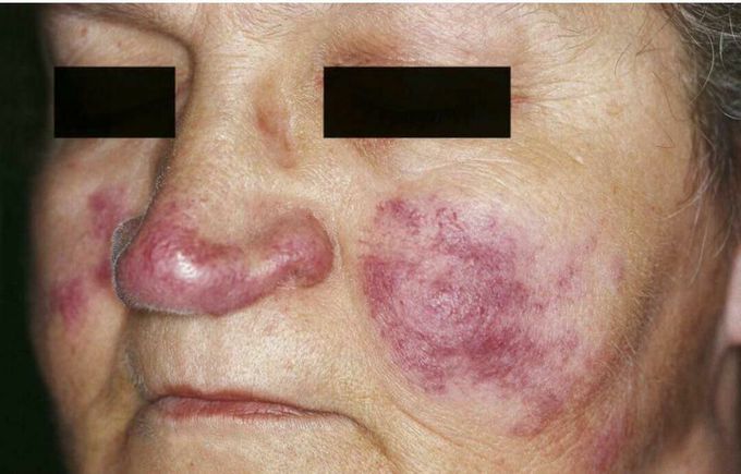 What is the diagnosis?