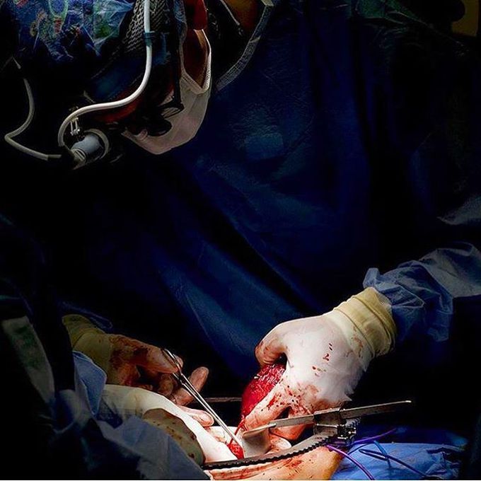 Successful removal of a kidney from a young female with Wilms' tumor!  