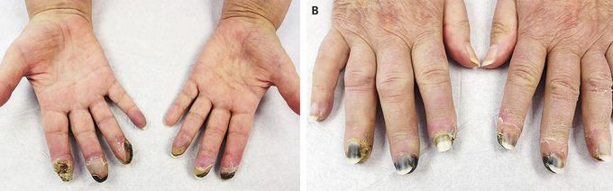 Bilateral Digital Ischemia