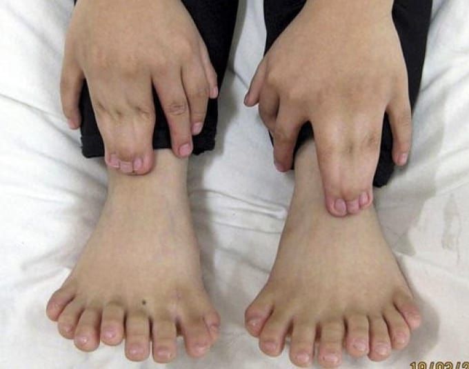 Synpolydactyly