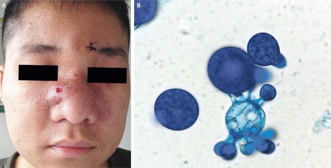 Rhinofacial Entomophthoromycosis