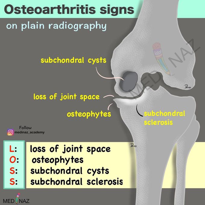 Signs of osteoarthritis