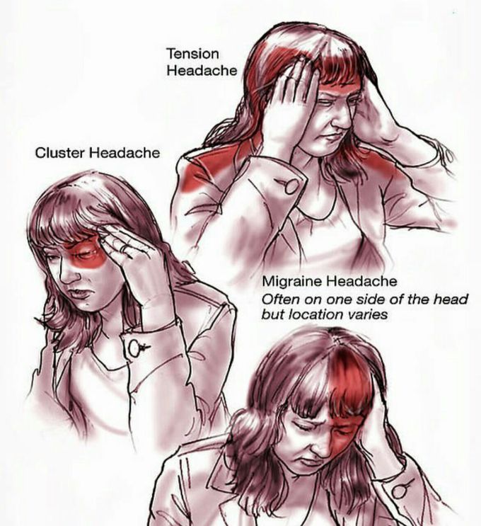 Common Locations of Headache Pain